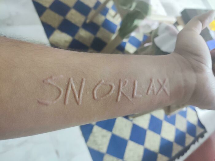 Tengo una enfermedad de la piel llamada dermatografía, por la que al rascarme ligeramente la piel me salen unas líneas rojas donde me he rascado