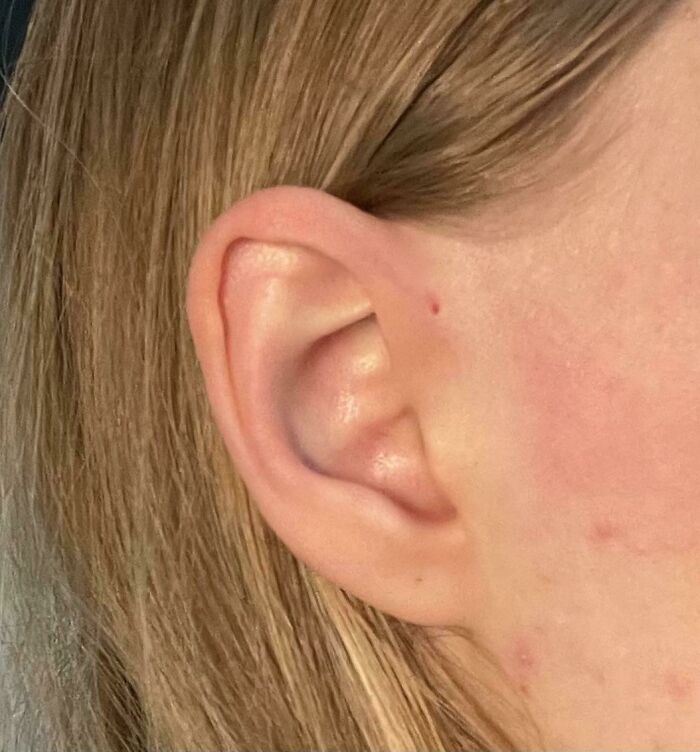 Nací con un agujero en la parte superior de la oreja que solía "llorar" cuando era un bebé