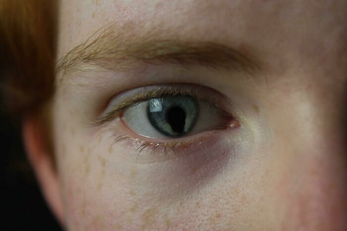 Una foto que un amigo tomó hace un tiempo de mis ojos que muestra mi rara condición ocular, doble coloboma (del iris y la retina). Tengo esto en ambos ojos