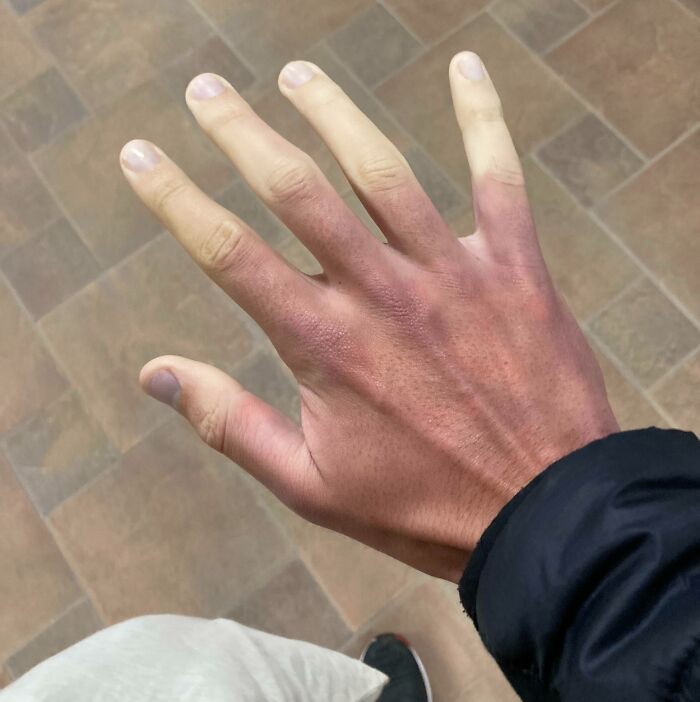 Tengo una cosa llamada enfermedad de Raynaud. Esto sucede cuando tengo frío