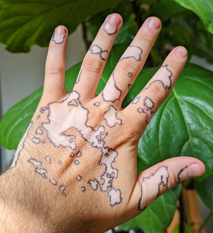 Dibujé alrededor de mis manchas de vitíligo