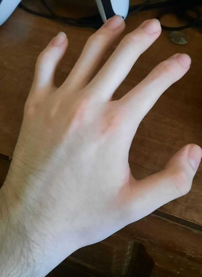 Ninguno de mis dedos de las manos (o de los pies) tiene nudillos centrales, y es hereditario
