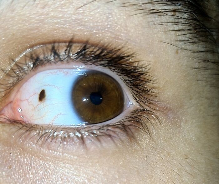 Tengo una peca en el ojo
