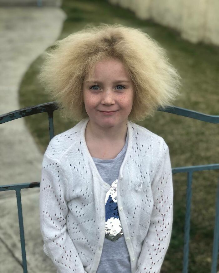 Shilah Madison nació con una condición por la cual su cabello se levanta constantemente
