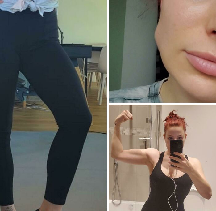 Tengo Hipertrofia Muscular (Los músculos crecen sin ejercicio). Ayer me puse botox en la mandíbula por esto