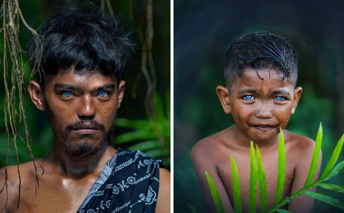 Condición genética rara y única que se conoce como síndrome de Waardenburg. Puede causar pérdida de audición y cambios en la coloración (pigmentación) del cabello, la piel y los ojos
