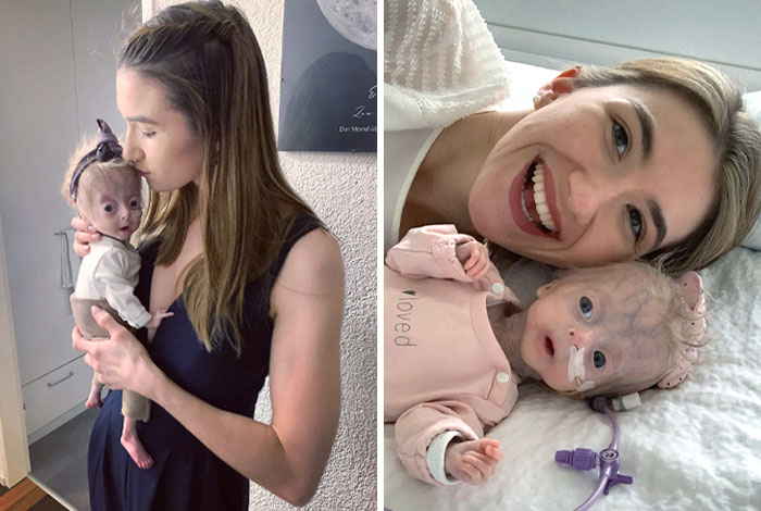 Progeria neonatal o síndrome de Hutchinson-Gilford. Un trastorno genético progresivo que hace que los niños envejezcan rápidamente, a partir de sus dos primeros años de vida