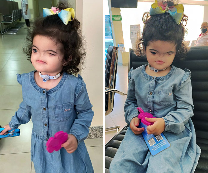 El síndrome de Bam es un raro trastorno genético en el que los niños nacen con una nariz pequeña o sin nariz. Además, pueden tener problemas de visión y en los ojos