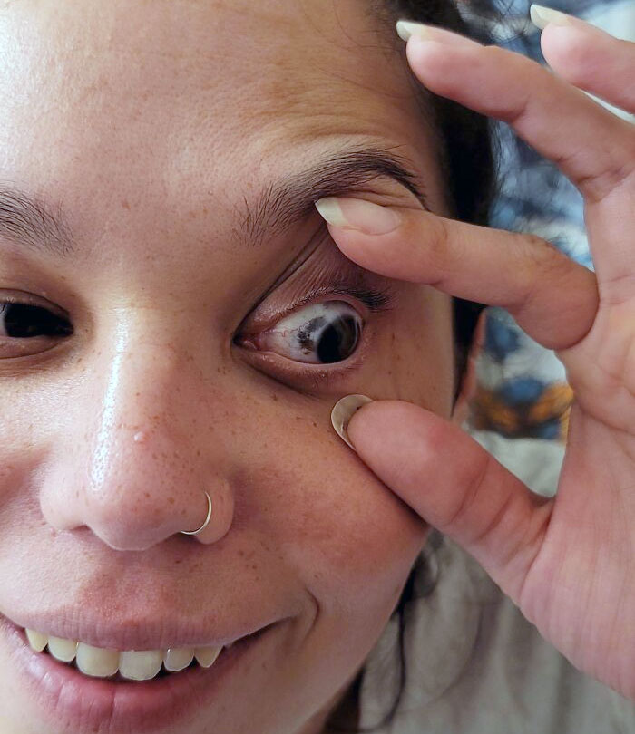 La marca de nacimiento de mi novia en su ojo