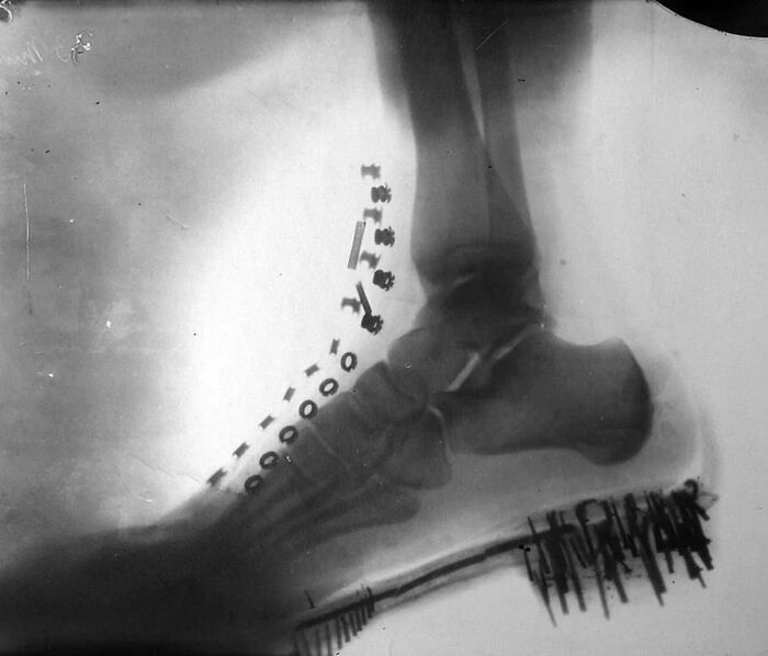 Radiografía del pie de Nikola Tesla tomada por él mismo en una máquina que diseñó (1896)