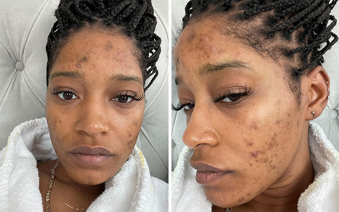 Cuando Keke Palmer compartió, y siguió poniéndonos al día, su experiencia con el síndrome de ovario poliquístico (SOP) y cómo afecta a su piel