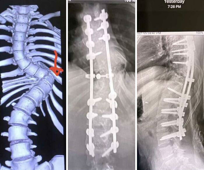 Un amigo mío tenía escoliosis y estas son las fotos de su cirugía