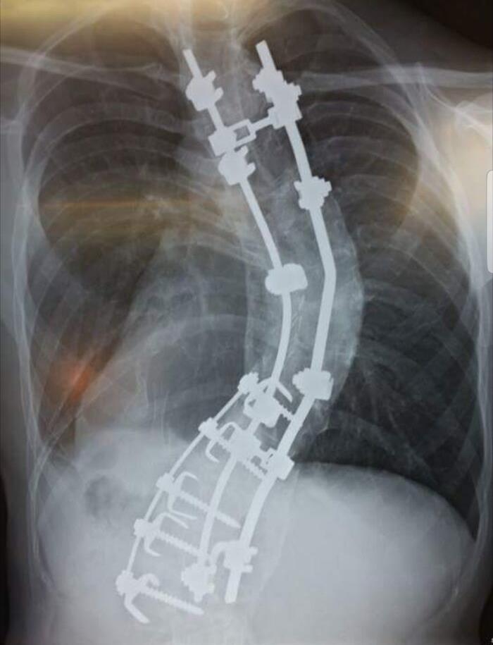 Mi columna vertebral. Entré para la cirugía midiendo 1,78 m, al salir medía 1,88 m, se supone que debería medir 2 m