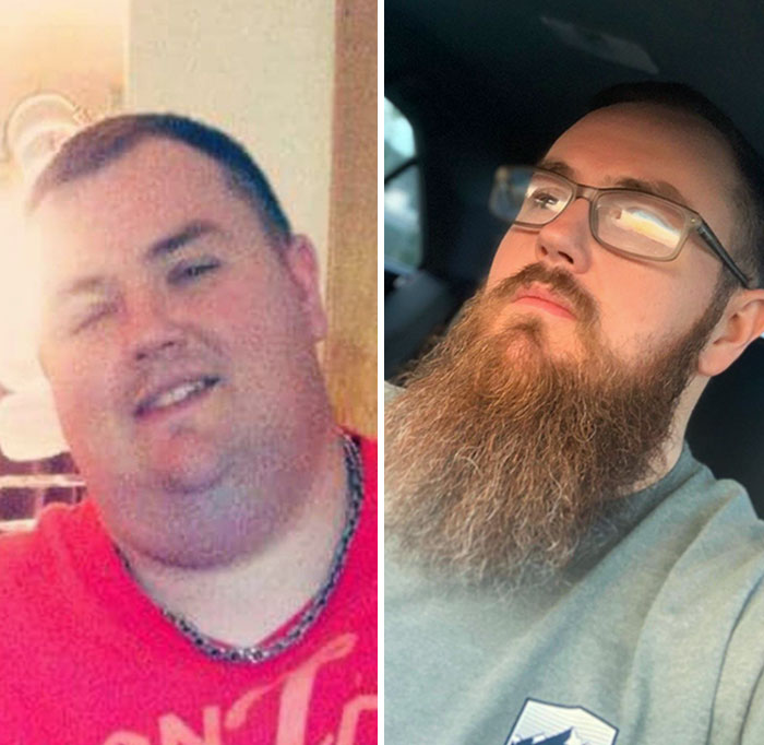 Perdí 100 kilos y gané una barba para cubrir mi cuello de pavo de la piel suelta