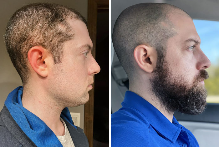 Tuve una caída de pelo pero me conseguí una barba