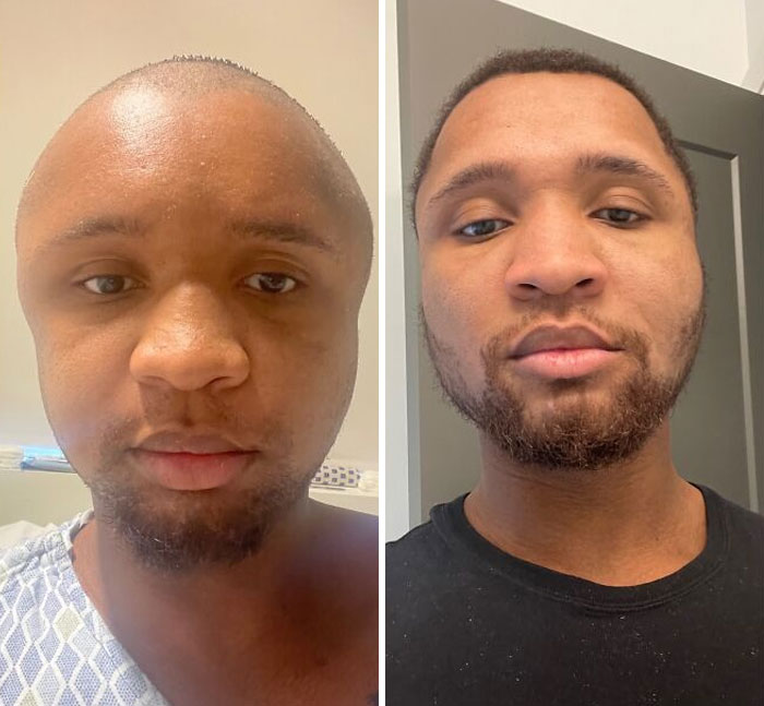 Tuve una reconstrucción facial hace 2 meses. Me decían Megamente, Ken Griffey Jr, Jimmy Neutron, etc. Ya pasaron 8 semanas y me siento mucho más seguro de mi aspecto 
