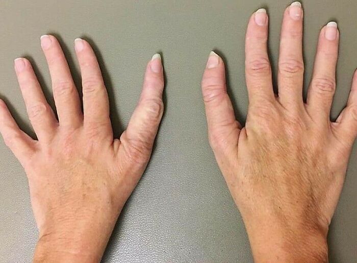 Malformación congénita de pulgar trifalángico