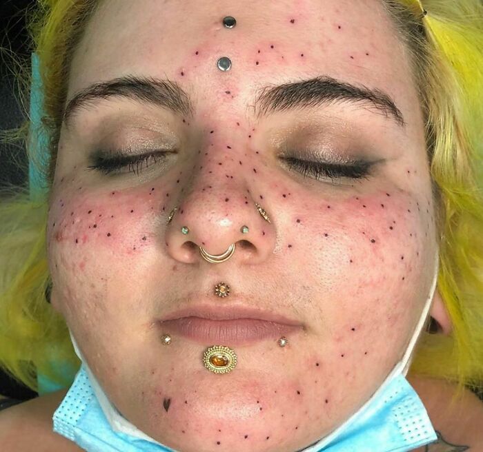 Se tatuó pecas y parecen puntos negros