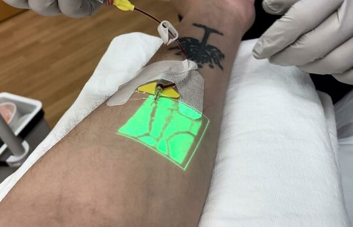Enfermera usando una herramienta de infrarrojos para encontrar una vena y poner una vía intravenosa