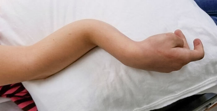 Me rompí el brazo cuando tenía 11 años. Ni siquiera lloré