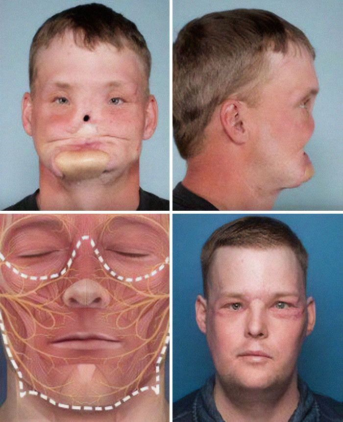 Transplante facial