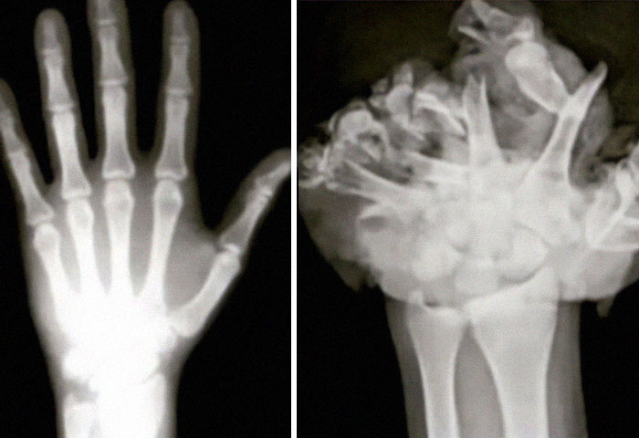 Mano normal y mano tras la explosión de un petardo