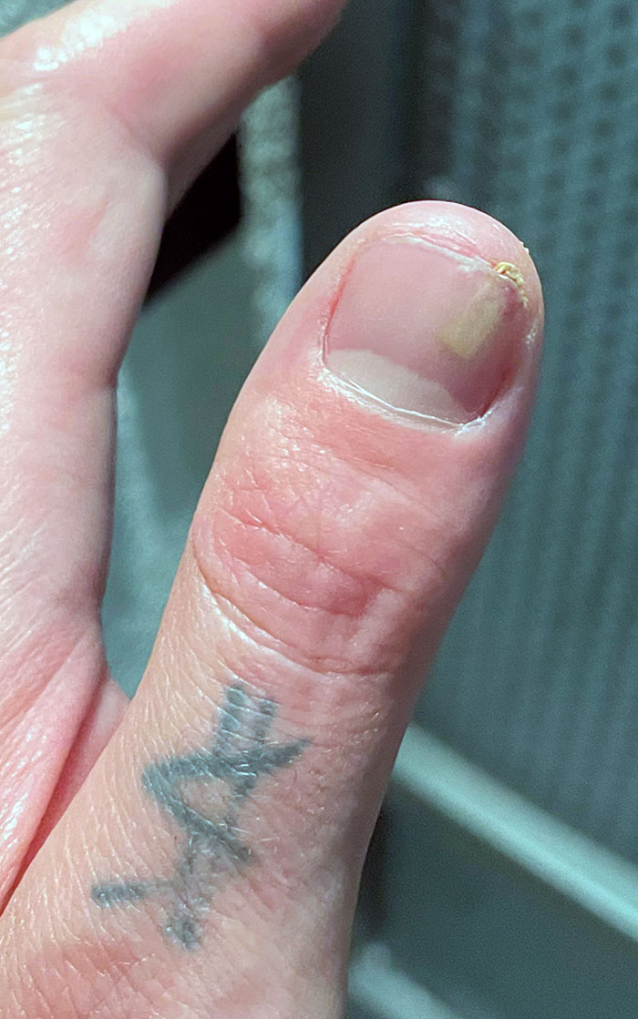 Se me ha metido una astilla bajo la uña del pulgar