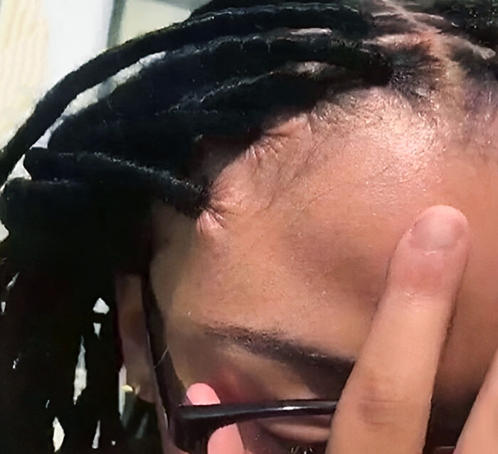 Rastas demasiado apretadas