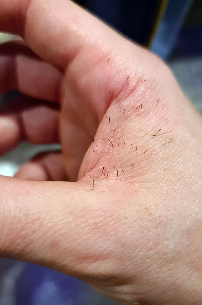 Intenté coger un cactus que se caía. Hay varias espinas bajo la piel que no se pueden sacar