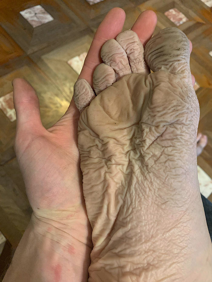 Mi pie tras llevar una bota mojada con un agujero durante 10 horas