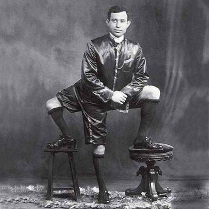Francesco Lentini, italoamericano nacido con 3 piernas, 4 pies y 2 juegos de genitales funcionales. Pasó la vida trabajando en el circo y murió a los 77 años