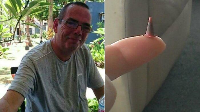 Este hombre fue operado urgentemente para quitarle un tumor canceroso del pulmón, pero los cirujanos descubrieron que no había tal, sino un cono de tráfico de juguete que inhaló hace 40 años