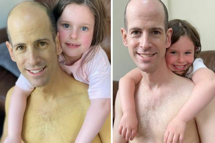 Antes y después de un transplante de hígado