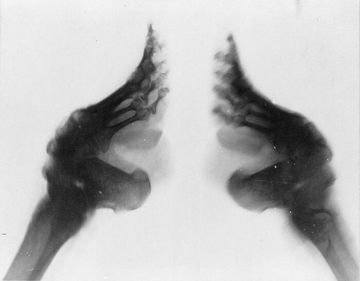 Radiografía de una mujer china a la que vendaban los pies
