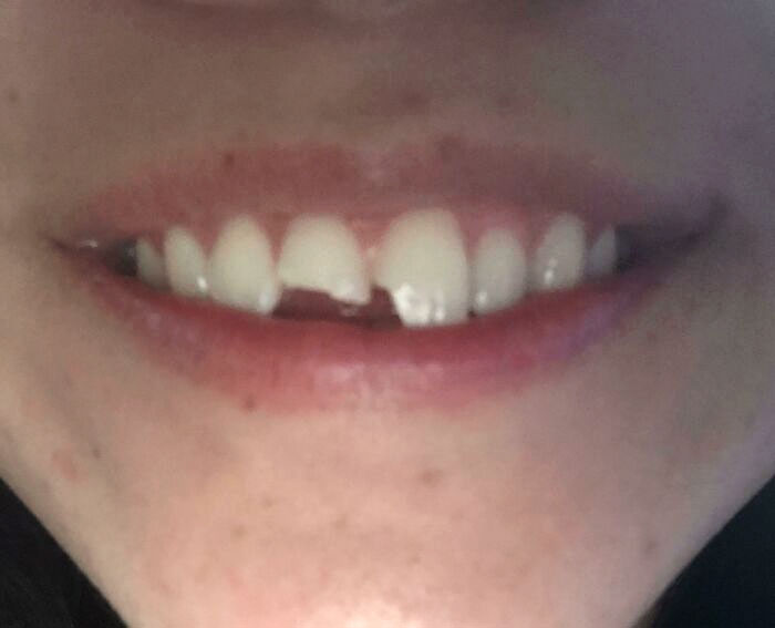 Me he roto los dientes a los 30 minutos de empezar el Año nuevo