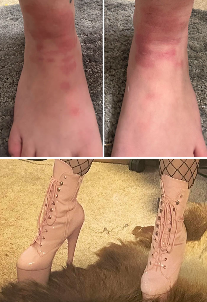 Mis tobillos tras bailar en mi turno de 12 horas en el club