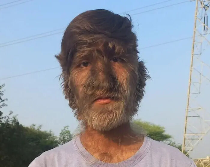 Adolescente de India con el síndrome del hombre-lobo (hipertricosis)