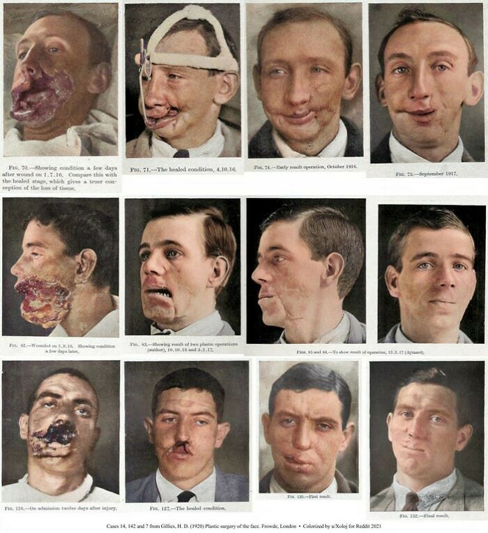 Reconstrucción facial durante la 1ª Guerra Mundial (1916-1917) [coloreadas]
