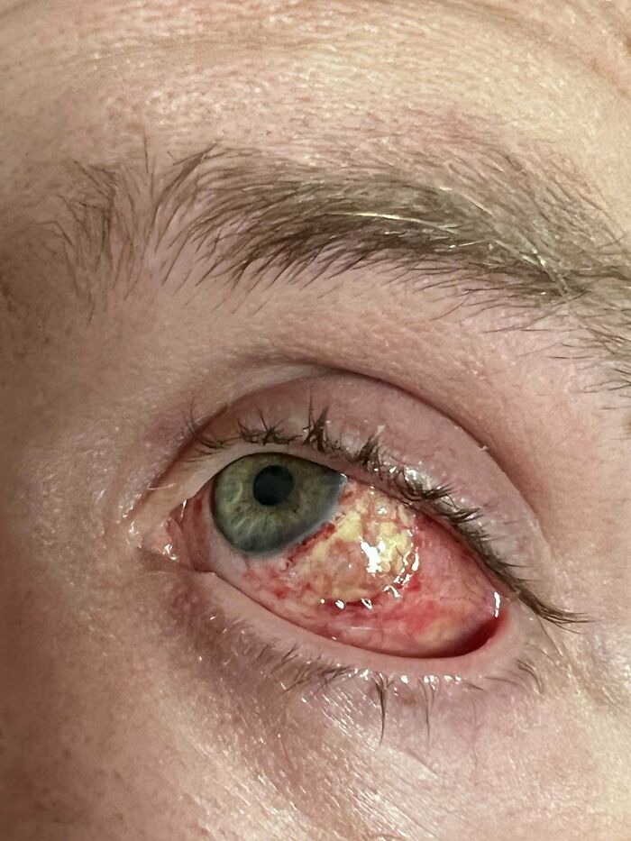 Mi hermano fue operado de un melanoma en el ojo