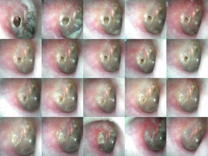 Una infección grave resistente a los antibióticos me provocó la rotura del tímpano. Compré un otoscopio digital y tomé una foto cada dos días mientras se curaba.