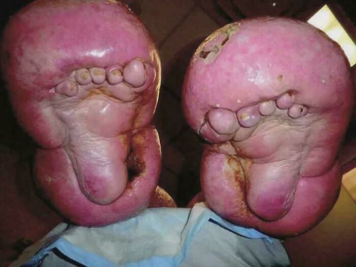Caso extremo de linfedema