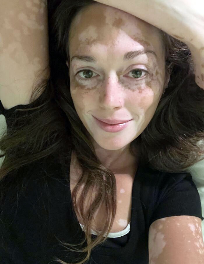 Un saludo a todos los que tenemos vitiligo. No sufráis, seguid sonriendo