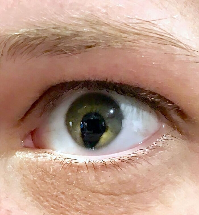 Tengo un agujero en la estructura del ojo, un coloboma