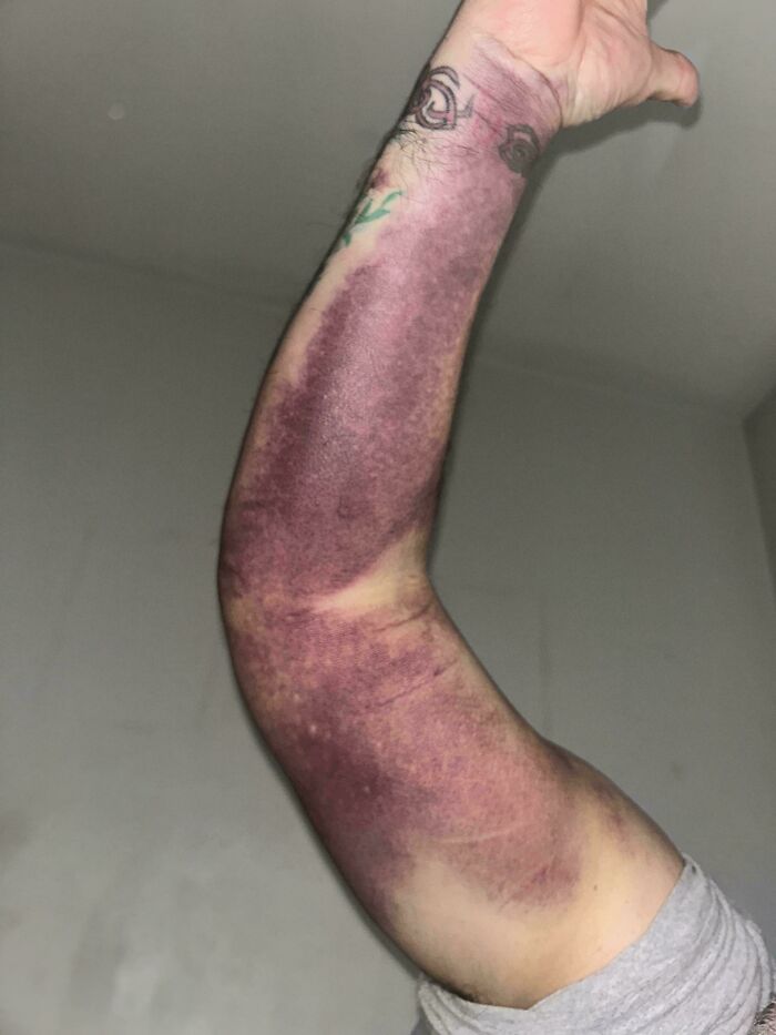 El brazo del padre de mi mejor amigo tras lesionarse boxeando