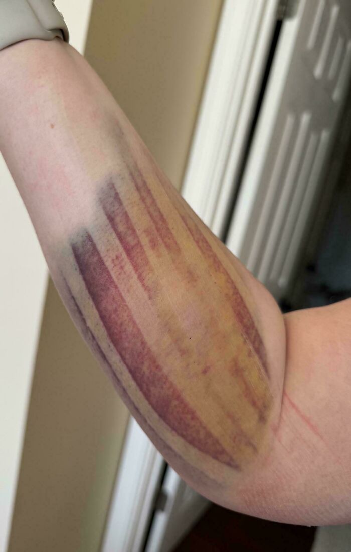 El moratón en mi brazo tras quitarme el vendaje neuromuscular