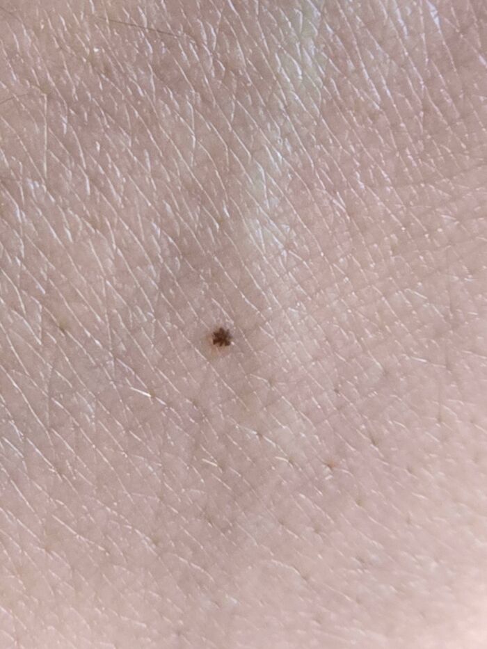 Esta peca diminuta en mi mano parece un asterisco