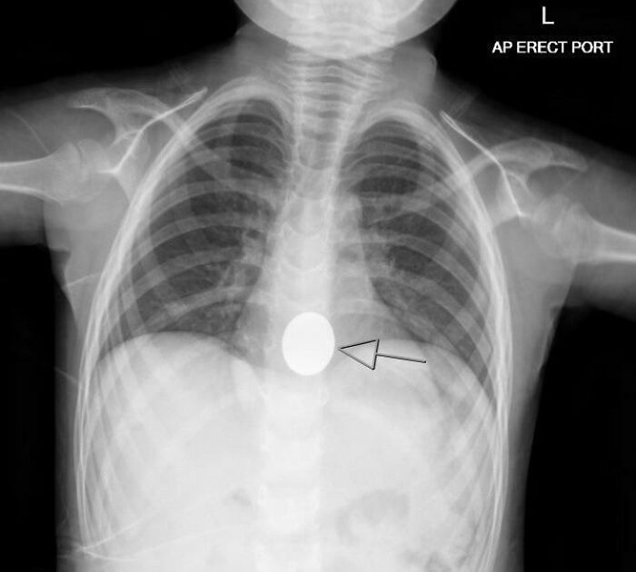 Mi hijo se ha tragado la moneda del carrito del supermercado