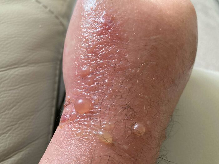 La mano de mi padre tras una picadura de abeja