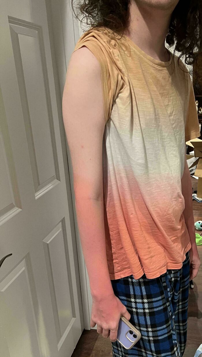 La quemadura solar de mi hijo coincide con el degradado de su camisa
