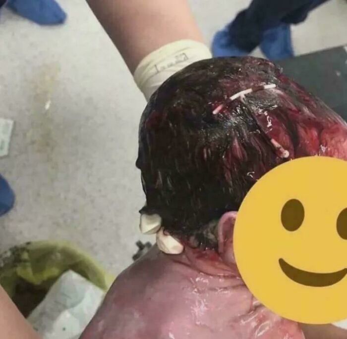 Nace un bebé con el dispositivo DIU de su madre en la cabeza